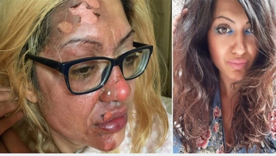 بيضة تشوه وجه امرأة بسبب حيلة على تيك توك صورة رقم 1