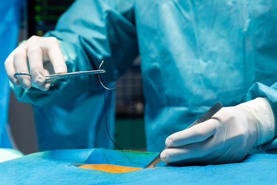 لتسريع الشفاء بعد الجراحة.. ابتكار خيوط قابلة للذوبان صورة رقم 3 لتسريع الشفاء بعد الجراحة.. ابتكار خيوط قابلة للذوبان صورة رقم 3