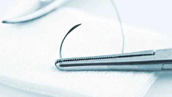 لتسريع الشفاء بعد الجراحة.. ابتكار خيوط قابلة للذوبان صورة رقم 9 لتسريع الشفاء بعد الجراحة.. ابتكار خيوط قابلة للذوبان صورة رقم 9