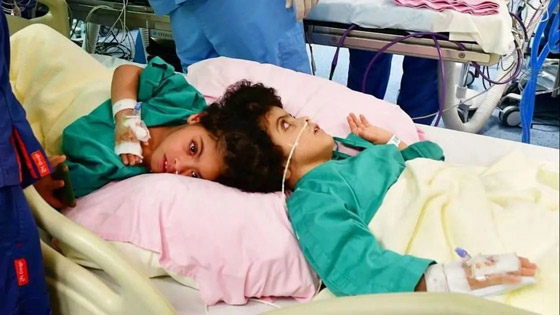 نجاح فصل السيامي المصري سلمى وسارة بالسعودية بعد 17 ساعة.. صورة رقم 6 نجاح فصل السيامي المصري سلمى وسارة بالسعودية بعد 17 ساعة.. صورة رقم 6