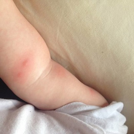 8 نصائح لتجنب لدغات البعوض في موسم الصيف والعطلات صورة رقم 2