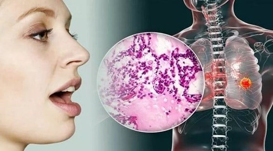 انتبهوا.. أعراض سهلة الملاحظة تنذر بسرطان الرئة صورة رقم 5
