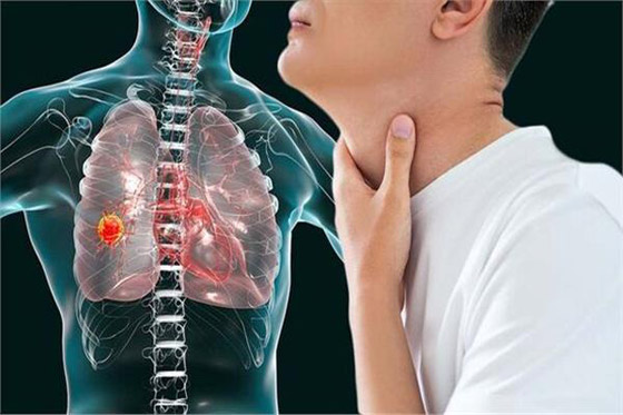 انتبهوا.. أعراض سهلة الملاحظة تنذر بسرطان الرئة صورة رقم 6