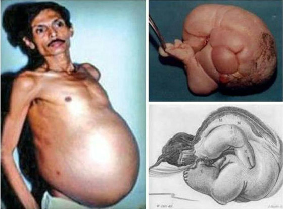 أغرب ما قد تسمعه على الإطلاق.. رجل هندي حامل لمدة 36 عاما! صورة رقم 2 أغرب ما قد تسمعه على الإطلاق.. رجل هندي حامل لمدة 36 عاما! صورة رقم 2