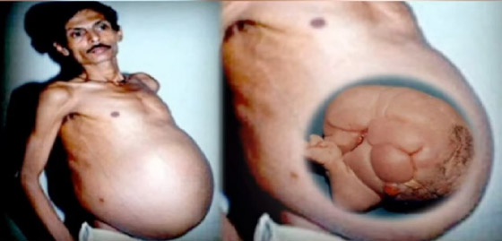 أغرب ما قد تسمعه على الإطلاق.. رجل هندي حامل لمدة 36 عاما! صورة رقم 4 أغرب ما قد تسمعه على الإطلاق.. رجل هندي حامل لمدة 36 عاما! صورة رقم 4