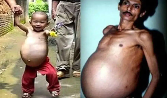 أغرب ما قد تسمعه على الإطلاق.. رجل هندي حامل لمدة 36 عاما! صورة رقم 1 أغرب ما قد تسمعه على الإطلاق.. رجل هندي حامل لمدة 36 عاما! صورة رقم 1