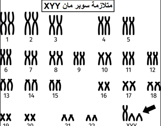 متلازمة سوبر مان حقيقة وليست خيال! ما هي؟ وكيف تحدث؟ صورة رقم 3