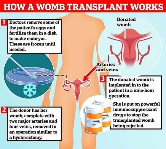 أخت تبرعت لشقيقتها.. نجاح أول عملية زراعة رحم في بريطانيا! فيديو صورة رقم 8 أخت تبرعت لشقيقتها.. نجاح أول عملية زراعة رحم في بريطانيا! فيديو صورة رقم 8