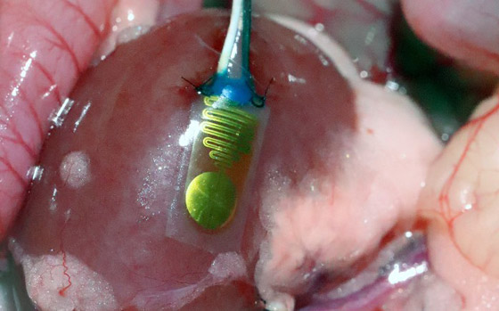 أول جهاز إنذار لمراقبة صحة الأعضاء المزروعة! صورة رقم 7