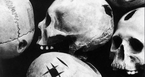 لماذا كان الإنسان القديم يثقب جمجمته؟ صورة رقم 4