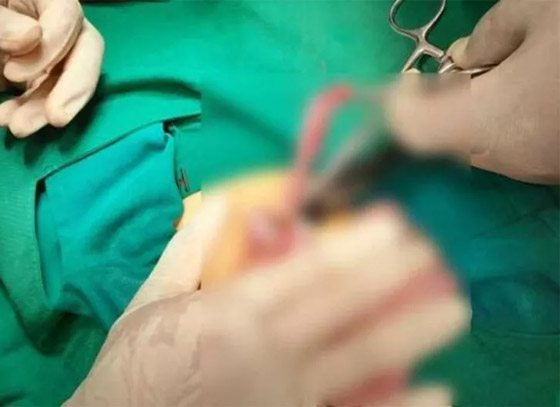 كيف فعلها؟ طفل يبتلع 8 إبر حقن والأطباء يتدخلون بـ