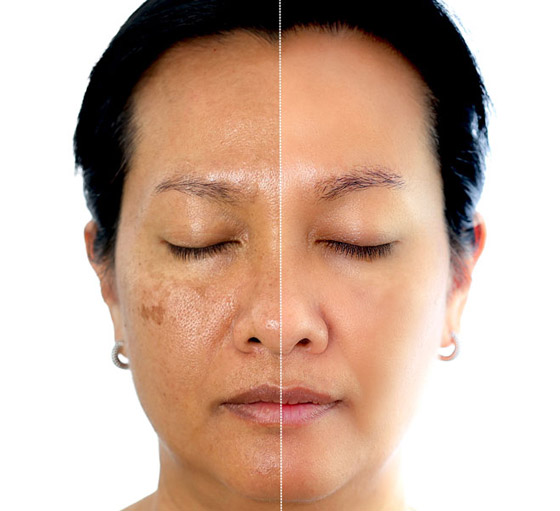 هذان المكونان هما الأفضل للتخلص من البقع الداكنة صورة رقم 4 هذان المكونان هما الأفضل للتخلص من البقع الداكنة صورة رقم 4