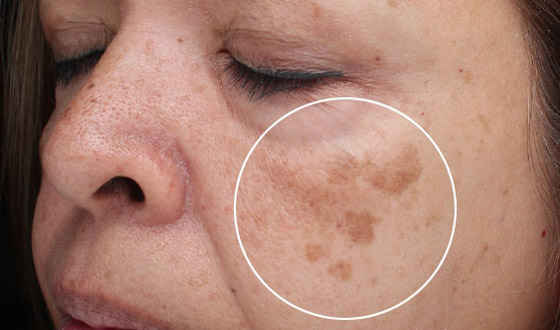 هذان المكونان هما الأفضل للتخلص من البقع الداكنة صورة رقم 5 هذان المكونان هما الأفضل للتخلص من البقع الداكنة صورة رقم 5