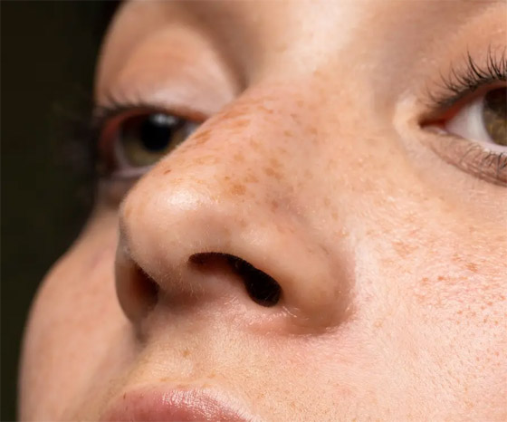 هذان المكونان هما الأفضل للتخلص من البقع الداكنة صورة رقم 6 هذان المكونان هما الأفضل للتخلص من البقع الداكنة صورة رقم 6