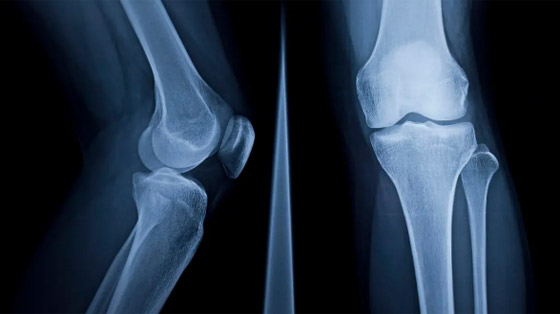 لعظام قوية.. 10 مكسرات وفواكه جافة صورة رقم 11 لعظام قوية.. 10 مكسرات وفواكه جافة صورة رقم 11