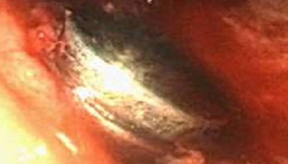 مراهق يبتلع 12 مغناطيسا ويُجبر على إجراء جراحة إسعافية.. صور صورة رقم 3 مراهق يبتلع 12 مغناطيسا ويُجبر على إجراء جراحة إسعافية.. صور صورة رقم 3