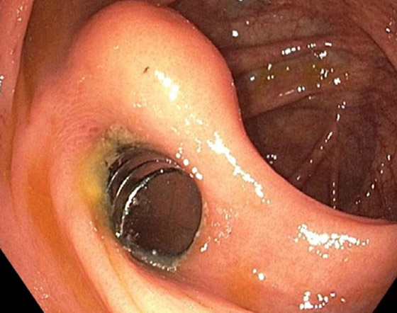 مراهق يبتلع 12 مغناطيسا ويُجبر على إجراء جراحة إسعافية.. صور صورة رقم 2 مراهق يبتلع 12 مغناطيسا ويُجبر على إجراء جراحة إسعافية.. صور صورة رقم 2