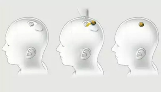 طوابير بالآلاف لتجربة شريحة إيلون ماسك للدماغ صورة رقم 1
