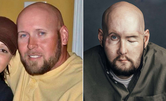 إنجاز طبي غير مسبوق.. تفاصيل أول عملية زراعة عين كاملة.. فيديو وصور صورة رقم 4