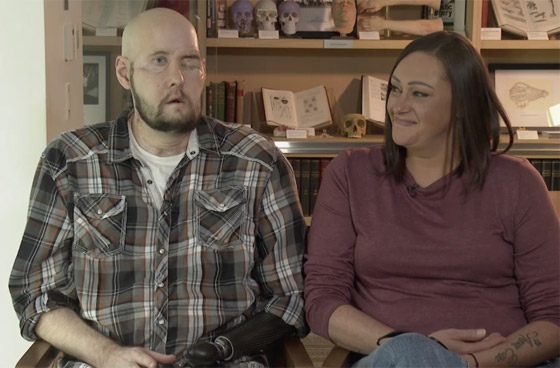 إنجاز طبي غير مسبوق.. تفاصيل أول عملية زراعة عين كاملة.. فيديو وصور صورة رقم 6