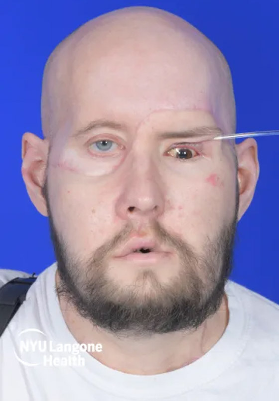 إنجاز طبي غير مسبوق.. تفاصيل أول عملية زراعة عين كاملة.. فيديو وصور صورة رقم 15