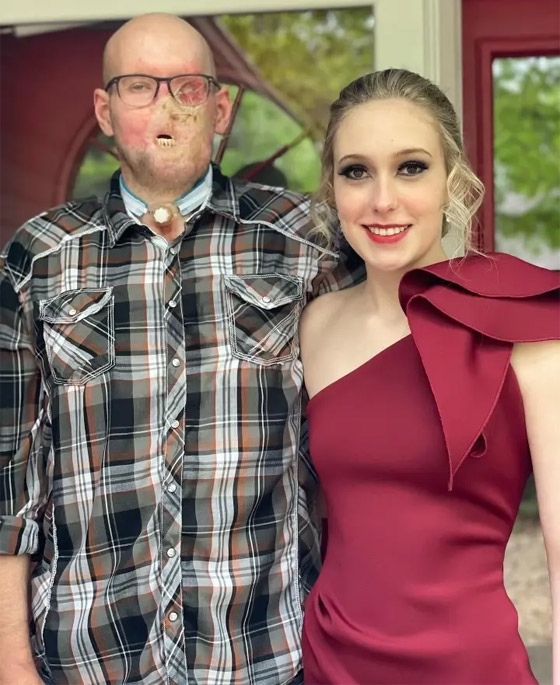 إنجاز طبي غير مسبوق.. تفاصيل أول عملية زراعة عين كاملة.. فيديو وصور صورة رقم 19