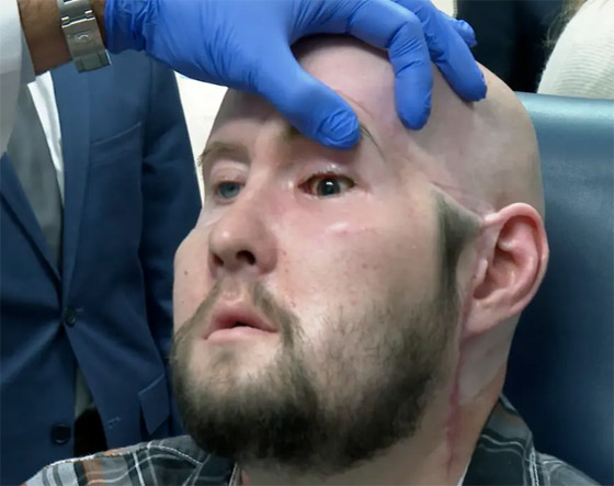 إنجاز طبي غير مسبوق.. تفاصيل أول عملية زراعة عين كاملة.. فيديو وصور صورة رقم 20