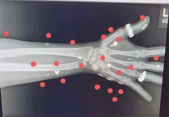 لديها قدرات خارقة.. سيدة تعيش بـ52 شريحة إلكترونية في جسدها (صور) صورة رقم 11