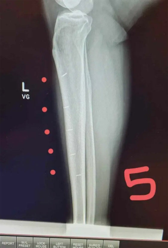 لديها قدرات خارقة.. سيدة تعيش بـ52 شريحة إلكترونية في جسدها (صور) صورة رقم 12