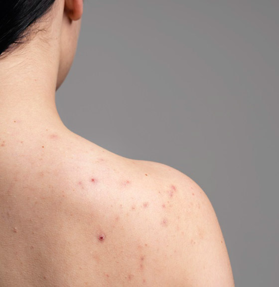 أسباب ظهور الحبوب في الظهر وأسرع علاجات للتخلص منها صورة رقم 2 أسباب ظهور الحبوب في الظهر وأسرع علاجات للتخلص منها صورة رقم 2