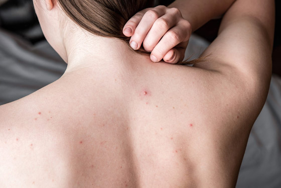 أسباب ظهور الحبوب في الظهر وأسرع علاجات للتخلص منها صورة رقم 1 أسباب ظهور الحبوب في الظهر وأسرع علاجات للتخلص منها صورة رقم 1