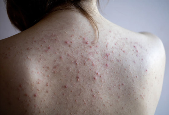 أسباب ظهور الحبوب في الظهر وأسرع علاجات للتخلص منها صورة رقم 3 أسباب ظهور الحبوب في الظهر وأسرع علاجات للتخلص منها صورة رقم 3
