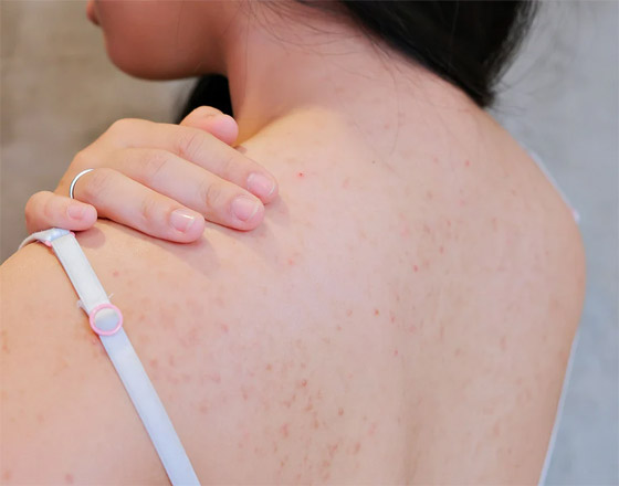 أسباب ظهور الحبوب في الظهر وأسرع علاجات للتخلص منها صورة رقم 4 أسباب ظهور الحبوب في الظهر وأسرع علاجات للتخلص منها صورة رقم 4