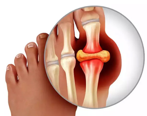 5 عناصر غذائية تتحكم في مستويات حمض البوليك صورة رقم 1