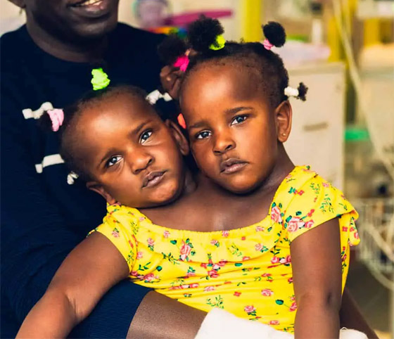 فيديو وصور: 6 من أغرب أنواع التوائم وأندرها في العالم صورة رقم 2