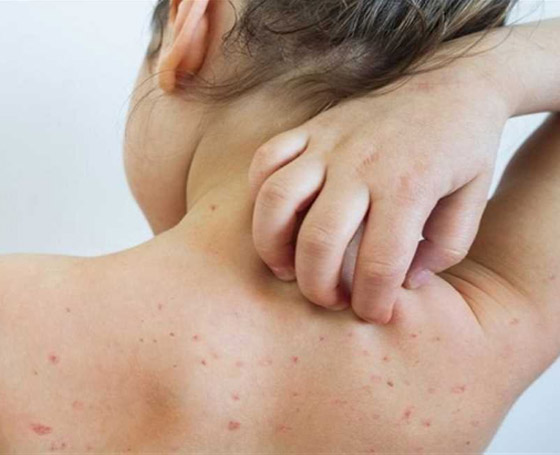 تعرف على أكبر 4 تهديدات صحية في العالم خلال 2024 صورة رقم 2