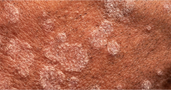 بعد وفاة جندي إسرائيلي بنوع مجهول منها التقطه في قطاع غزة.. أخطر 10 فطريات فتاكة مسببة للعدوى والموت صورة رقم 1