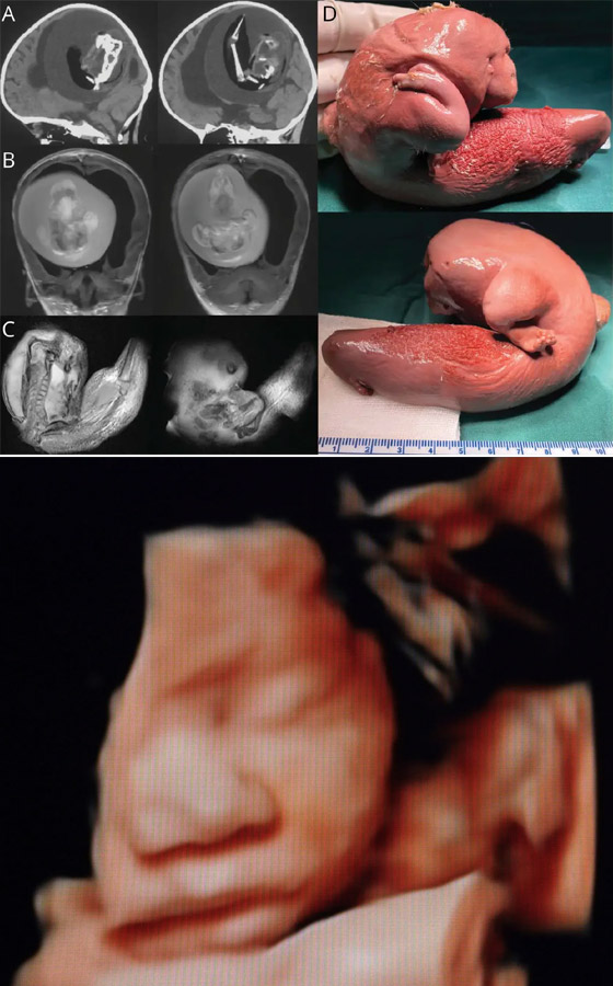 لسان بشعر وجنين داخل دماغ طفل.. أغرب الحالات الطبية في 2023 صورة رقم 2
