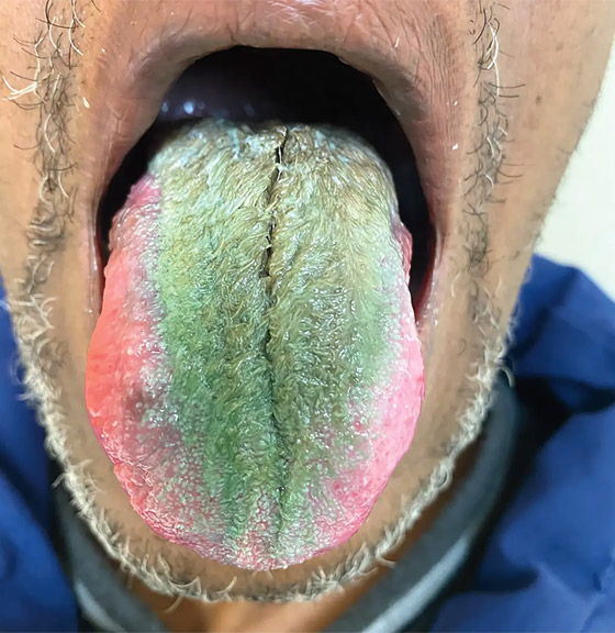 لسان بشعر وجنين داخل دماغ طفل.. أغرب الحالات الطبية في 2023 صورة رقم 3