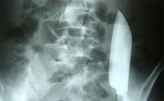 لسان بشعر وجنين داخل دماغ طفل.. أغرب الحالات الطبية في 2023 صورة رقم 1