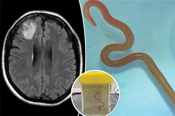 لسان بشعر وجنين داخل دماغ طفل.. أغرب الحالات الطبية في 2023 صورة رقم 4