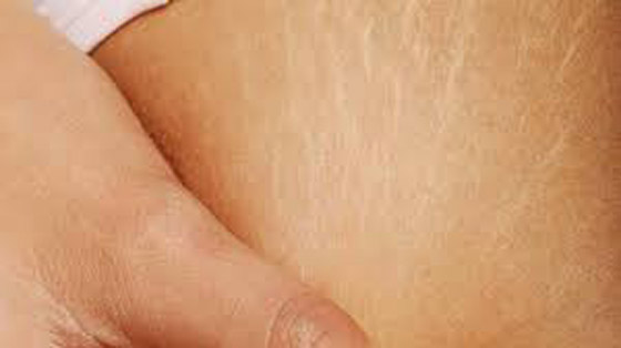 الخطوط البيضاء في الجسم تزعجكِ؟.. اكتشفي طرق علاجها صورة رقم 6