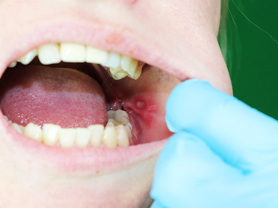 علاج تقرحات الفم في المنزل.. بطرق بسيطة وفعالة صورة رقم 5