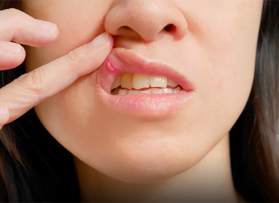 علاج تقرحات الفم في المنزل.. بطرق بسيطة وفعالة صورة رقم 6