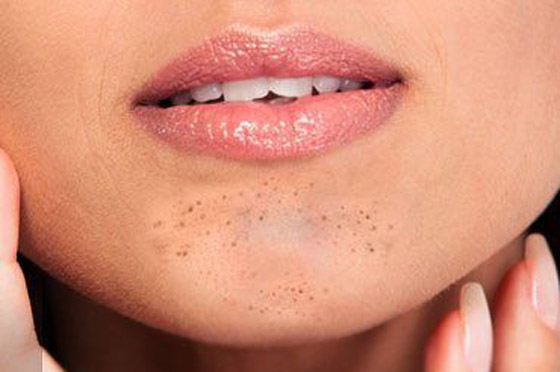 علاجات طبيعية لإزالة السواد حول الفم والذقن صورة رقم 6