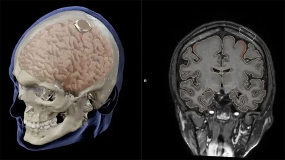 الملياردير إيلون ماسك يعلن عن نجاح زرع شريحة دماغية بأول إنسان صورة رقم 4