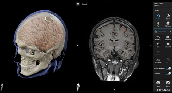 الملياردير إيلون ماسك يعلن عن نجاح زرع شريحة دماغية بأول إنسان صورة رقم 12