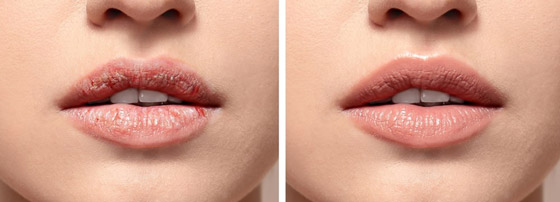 5 نصائح لشفاه خالية من العيوب.. اتبعيها صورة رقم 3