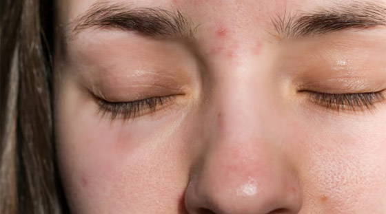 البثور بين الحاجبين... الأسباب والعلاج صورة رقم 2