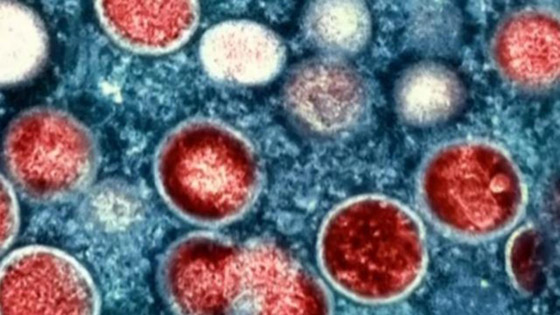 فيروس جديد يقتل أول مصاب به.. ماذا نعرف عن (جدري آلاسكا) ونصائح السلطات الصحية لتجنبه صورة رقم 6 فيروس جديد يقتل أول مصاب به.. ماذا نعرف عن (جدري آلاسكا) ونصائح السلطات الصحية لتجنبه صورة رقم 6